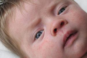 alergias en bebes