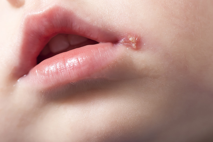 Ampollas En Los Labios O Comisuras Del Bebe Parasubebe