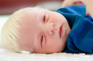 bebé albino