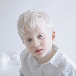 niño albino