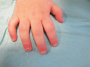 descamación de uñas en bebés